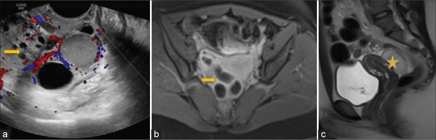 A 39-year-old woman presented with pyosalpinx presenting with abdominal and pelvic pain. (a) Ultrasonography shows an adnexal tubular lesion with internal echoes separate from the ovary (arrow). (b) Axial T1-WI-WI fat-saturated MRI shows dilated right tube (arrow) with enhancing walls and inflammation compatible with pyosalpinx. (c) Sagittal T2 non-fat-saturated MRI shows tubal inflammation (star) in the cul-de-sac with debris.
