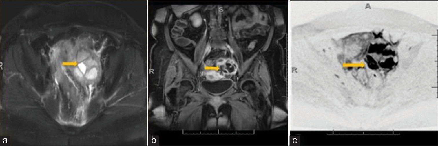 A 47-year-old woman presented with tubo-ovarian abscess presenting with fever and pelvic pain. (a) Axial T2 fat saturated shows marked edematous and enlarged ovary with loculations (arrow). (b) Coronal T1 fat saturated shows enhancing the left ovary with loculations (arrow). (c) Axial DWI shows marked restricted diffusion of the loculations (arrow), supporting abscess formation.