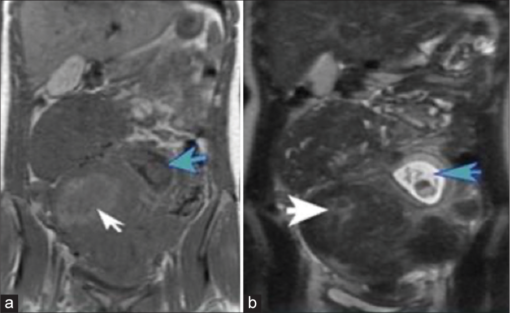 A 41-year-old woman presented with leiomyoma presenting with menstrual irregularities. (a) Coronal T1 nonfat saturated shows multiple fibroids with a fundal fibroid demonstrating a high T1 signal (white arrow) and fetal pole (aqua arrow). (b) Coronal T2 steady-state fast spin-echo (SSFSE) shows a high signal due to edema (white arrow). Notice the fetal pole (blue arrow).