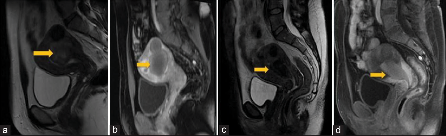 A 52-year-old woman presented with embolized leiomyoma presenting with dyspareunia. (a) Sagittal T2 and (b) post-contrast T1 fat saturated show a large submucosal fibroid before UAE (arrow). (c) Sagittal T2 and (d) post-contrast T1 fat-saturated post-embolization demonstrate sloughing fibroid (arrows).