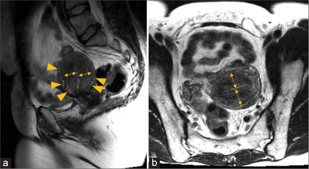 A 31-year-old woman presented with dysmenorrhea from adenomyosis. (a) Sagittal T2-weighted image, (b) axial T2-weighted MRI images show widening of the junctional zone (double head arrows) measures up to 1.7 cm and T2 hyperintensities (arrowheads) consistent with uterine adenomyosis.