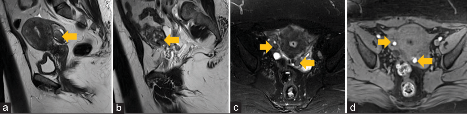 A 36-year-old woman presented with cyclical pelvic pain from endometriosis. (a) Sagittal T2-weighted image (left side), (b) sagittal T2-weighted image (right side), (c) axial T2-weighted image fat saturated, and (d) axial T1-weighted image fat-saturated MRI images demonstrate T1 hyperintense and T2 hypointense bilateral adnexal endometrial implants (arrow) separate from ovaries and consistent with endometriosis.