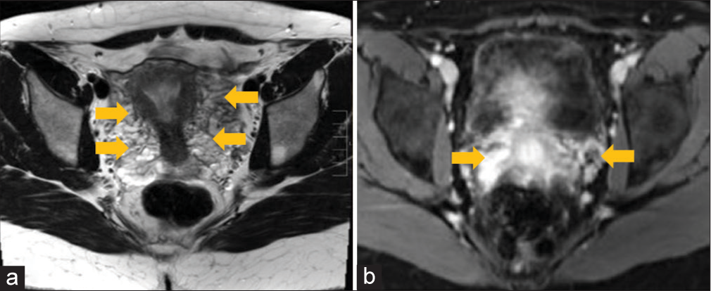 A 45-year-old woman presented with chronic pelvic pain from pelvic congestion syndrome. (a) Axial T2-weighted image, (b) post-contrast axial T1-weighted fat-saturated MRI images show enhancing pelvic and periuterine vessels (arrows) suggestive of pelvic congestion syndrome.