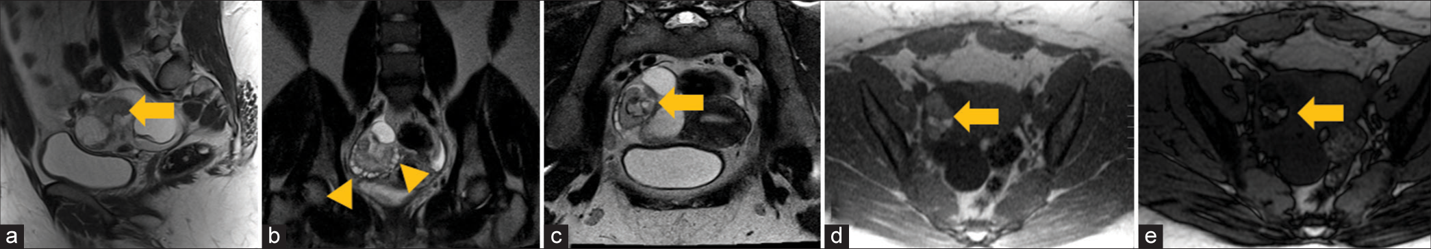 A 31-year-old woman presented with acute pelvic pain from ovarian torsion due to a dermoid. (a) Sagittal T2-weighted image, (b) coronal T2-weighted image, (c) axial oblique T2-weighted image, (d) in-phase, and (e) out-phase MRI images demonstrate enlarged heterogeneous right ovary with a 4.5 cm ovarian teratoma (arrow) along with several additional ovarian cystic lesions (arrowhead). There is a signal dropout on out-of-phase images consistent with intralesional fat. These findings are consistent with ovarian torsion.