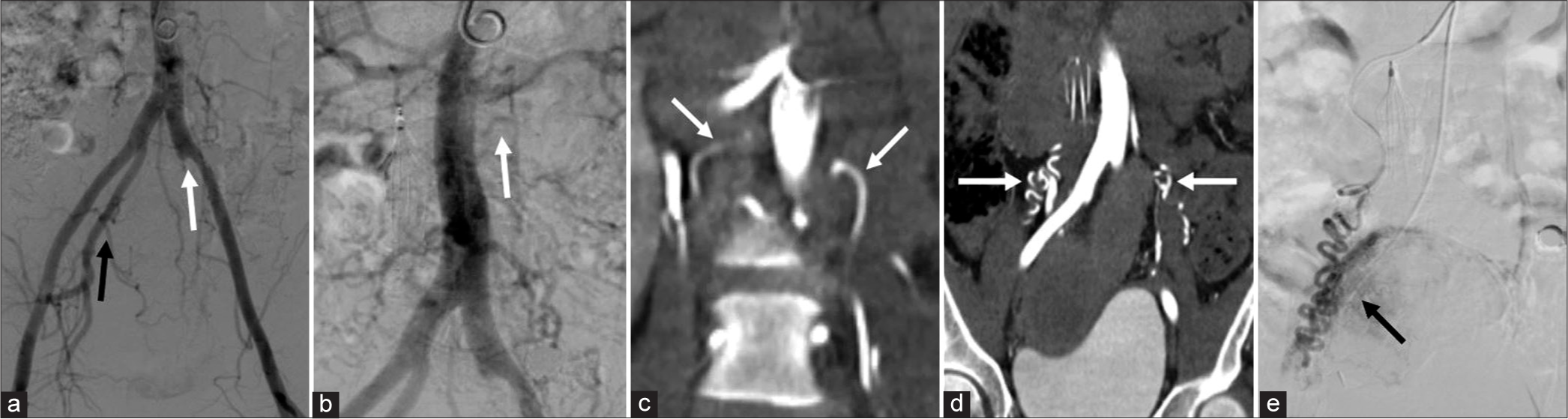 (a) 46-year-old female with ovarian fibroids and menorrhagia. Plan for uterine fibroid embolization (UFE). Mapping for UFE can be complicated by distorted pelvic anatomy (i.e. enlarged uterus) and the possibility of collateral uterine supply. Initial abdominal aortic DSA above demonstrates occlusion of the left internal iliac artery at its origin (white arrow), and no significant right uterine artery (black arrow). (b) The ovarian vessels were presumed to be the dominant blood supply; however, aortic fluoroscopic angiograpy only faintly revealed the left ovarian artery (arrow). (c) Aortic CDCTA revealed the origin of both ovarian vessels (white arrows). (d) Aortic CDCTA also confirmed a tortuous hypertrophied course into the pelvis to supply the uterus (white arrows). (e) After successful right ovarian artery cannulation, DSA revealed prominent uterine uptake (arrow).