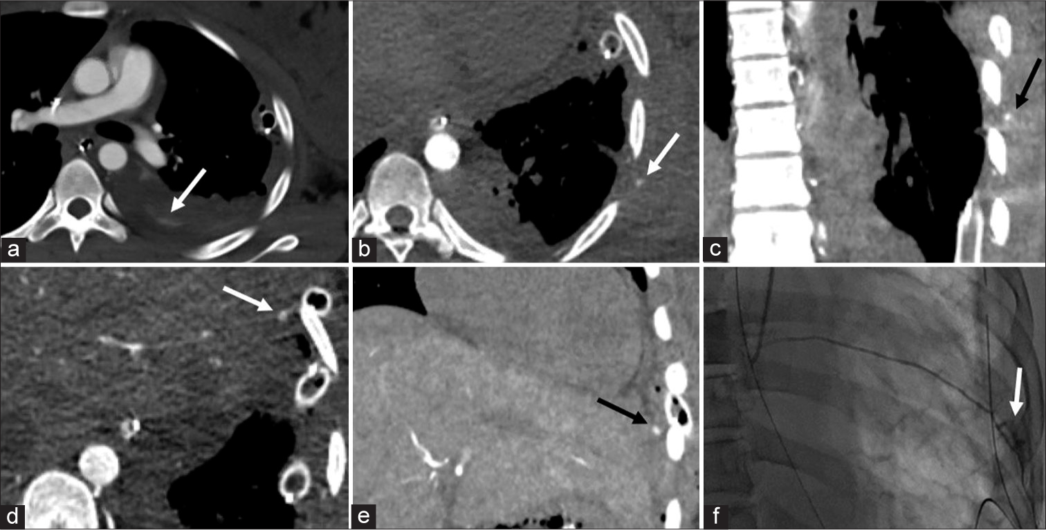 (a) 19-year-old female s/p MVC with rib fractures and bloody output from chest tube. Plan for angiogram with possible subsequent embolization. In cases of intercostal artery hemorrhage, identifying the involved thoracic level is important for quick cannulation and embolization. Conventional axial CTA did not demonstrate active arterial extravasation, with only non-localized pooling of contrast in the pleural space in the venous phase (arrow). (b) CDCTA via the aorta identified active extravasation in the 7th intercostal artery (arrow), axial view. (c) Coronal view complimentary to Figure 3b. (d) CDCTA via the aorta also revealed active extravasation of the 8th intercostal artery (arrow), axial view. (e) Coronal view complimentary to Figure 3d. (f) Targeted cannulation and arteriogram confirmed the findings. Increased contrast conspicuity over conventional CTA allowed for visualization of the bleed (arrow).