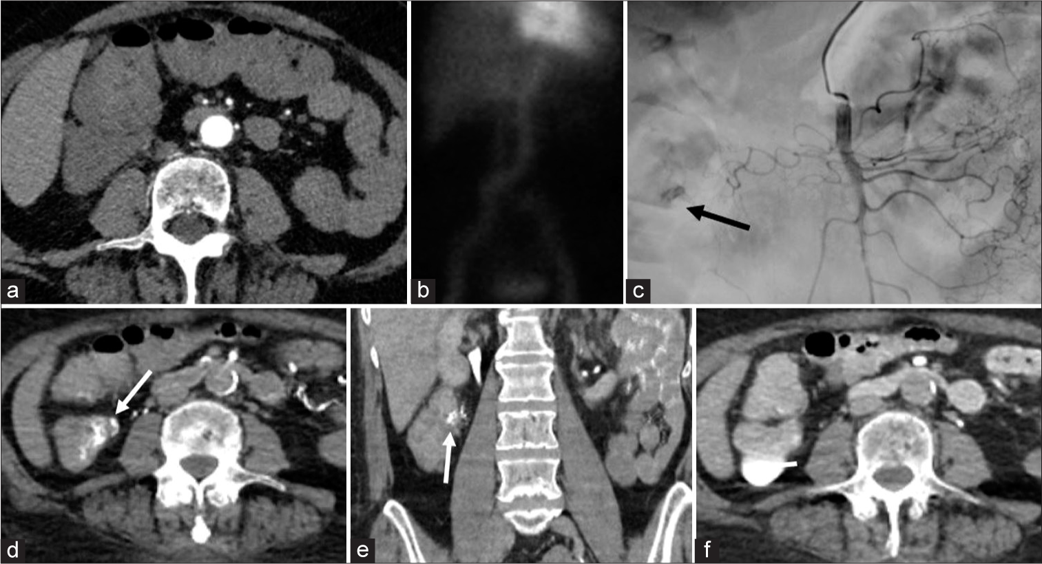 (a) 67-year-old female with history of colonic diverticulosis presents with lower GI bleeding, and decreased hemoglobin level. Detecting GI hemorrhage with conventional imaging methods is limited due to the intermittent nature of active arterial extravasation as well as the sensitivity of the exam. Axial conventional CTA demonstrated no extravasated contrast. (b) Tagged red blood cell nuclear machine failed to identify the bleed in this patient with clinically significant hemorrhage. (c) During a period of suspected ongoing hemorrhage, DSA via the SMA identified a region of possible extravasation from a right colic branch (arrow). (d) Sub-selective CDCTA demonstrated active extravasation from the suspected right colic branch (arrow), axial view. (e) Coronal view complimentary to Figure 4d. (f) Venous CDCT further confirmed the findings with pooling of extravasated blood.