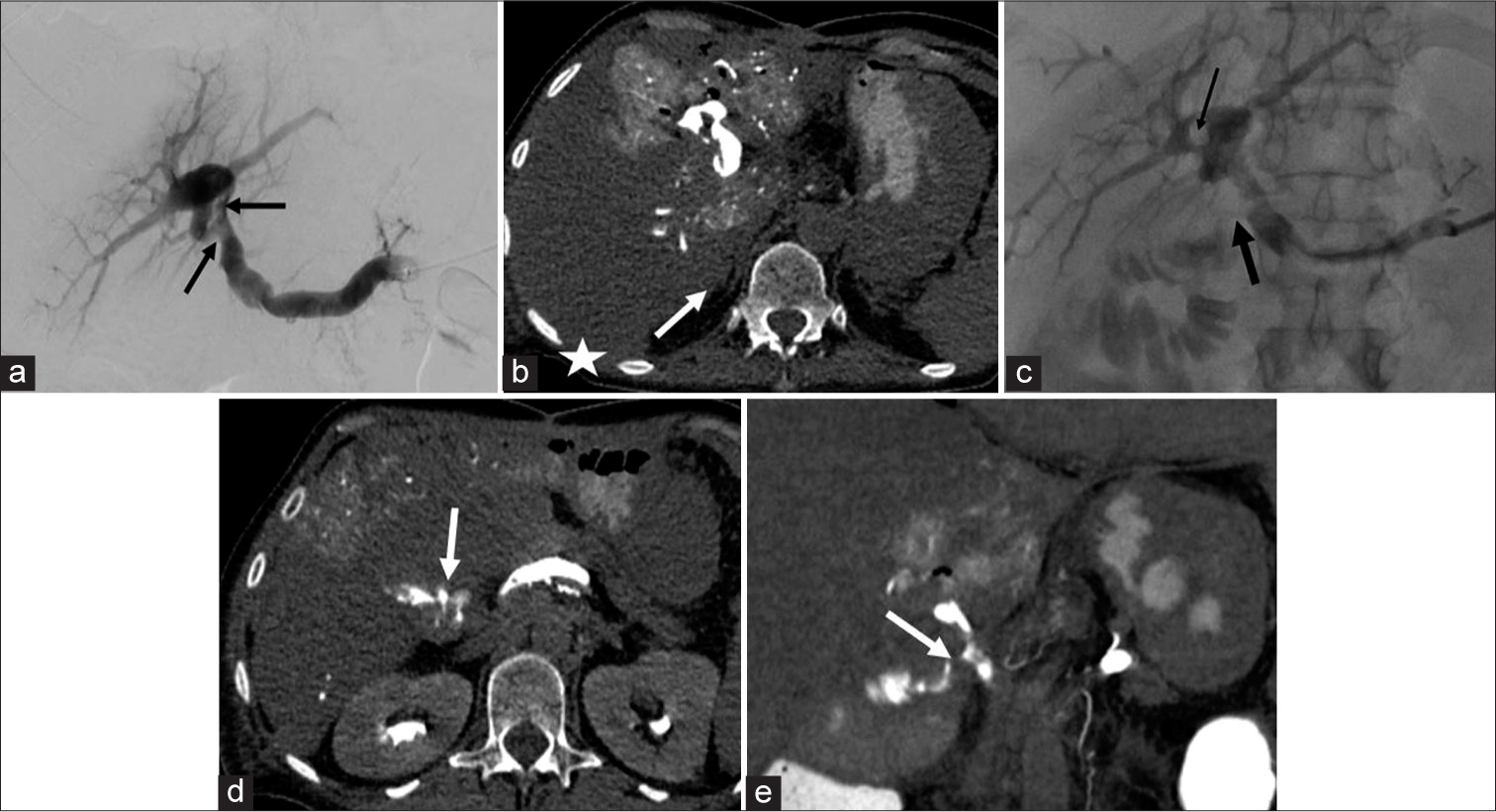 (a) 65-year-old female with suspected infected portal venous clot. Plan for portal venogram and suction thrombectomy. Removal of a portal venous clot unmasked a portal venous-bowel fistula in a patient with a complex abdominal surgical history, including recent Whipple for pancreatic carcinoma. Initial trans-splenic portal venogram demonstrates scattered filling defects (black arrows). (b) Portal venous CDCT demonstrates the clot (arrow) as well as non-opacification of the right portal venous system (star) due to the chronic occlusive right portal vein thrombus. (c) After partial suction thrombectomy, a portal vein-bowel fistula was revealed on portal venogram (black arrows). (d) Portal venous CDCT more precisely described the fistula as involving the choledochojejunostomy loop used in the patient’s Whipple (arrow), axial view. High resolution CDCT in a large field of view aided in surgical planning in the setting of prior abdominal surgeries. (e) Coronal view complimentary to Figure 5d.