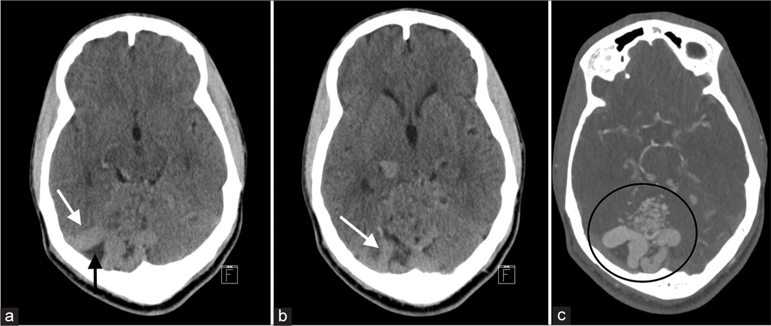 (a-c) Non-contrast CT images demonstrate an AVM with multiple areas of high attenuation within the brain (white arrow, a and b), many of which are sharply defined and serpiginous. The conspicuity of these structures reflects the expected higher than brain attenuation of normal blood within enlarged blood vessels. Additional regions of hypoattenuation surrounding these vessels may indicate edema or encephalomalacia (black arrow, a). The CTA at the same level shows corresponding abnormal vascular structures characteristic of an AVM (circle, c).
