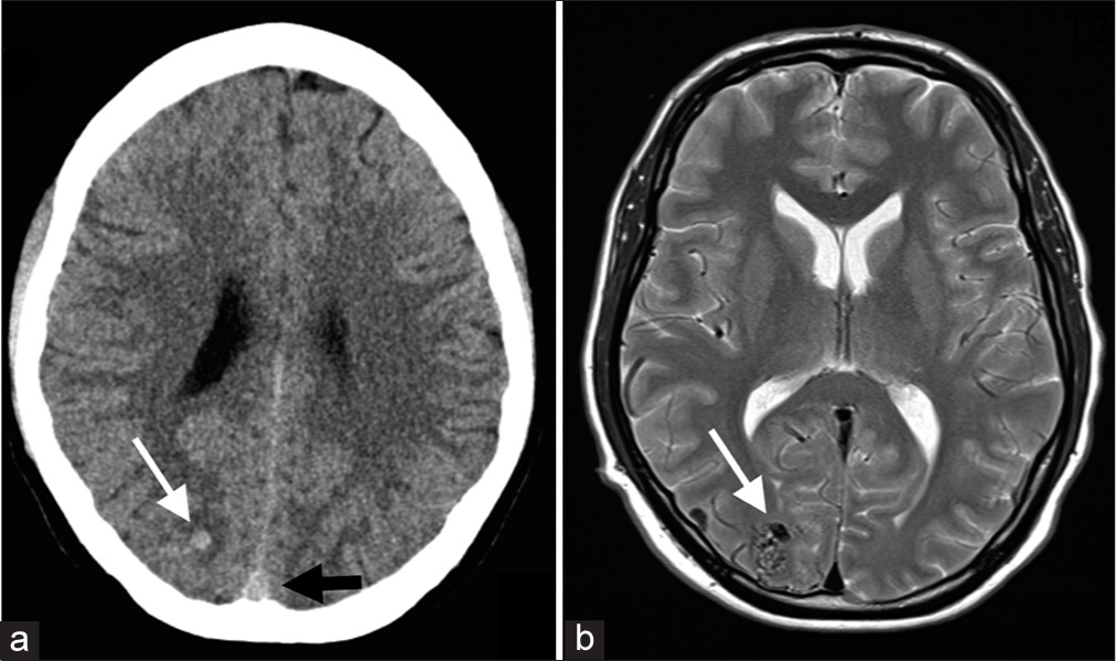 (a and b) Non-contrast CT image demonstrates a focal area of high attenuation (white arrow, a) in the parietal white matter without calcifications or adjacent low attenuation. While hemorrhage is a consideration, note how its attenuation resembles that of the intravascular blood in the superior sagittal sinus (black arrow). This observation broadens the differential to include an abnormal vascular structure, in these cases, small AVMs, as well as hemorrhage and cavernoma. The T2-weighted MR scan at the same level (b) reveals multiple flow voids consistent with intravoxel dephasing from high-velocity flow in the nidus of this small AVM that was proven on DSA based on arteriovenous shunting.