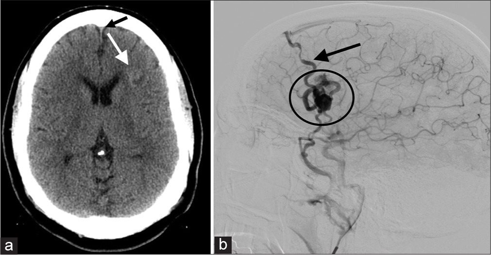 (a and b) Non-contrast CT image shows a subtle abnormality with asymmetric high attenuation in the left frontal lobe white matter (white arrow, a). While hemorrhage is again a consideration, note how its attenuation resembles that of the intravascular blood in the superior sagittal sinus (small black arrow, a). The corresponding DSA (b) demonstrates typical features of an AVM. Note the nidus (circle, b) and early appearance of a superficial vein (black arrow, b) draining into the superior sagittal sinus during the arterial phase of injection into the patient’s left carotid artery.