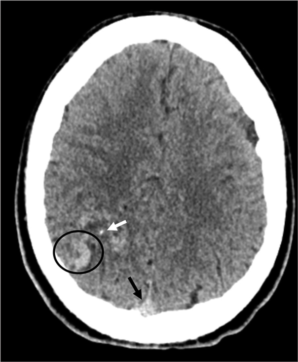 This non-contrast CT demonstrates the characteristic appearance of an AVM. Note the curving hyperdense structure (circle) with the same attenuation as the superior sagittal sinus (black arrow). Also note the focal calcification (white arrow). This combination of findings was evident in half of our cases where the AVM was visible on NCCT.