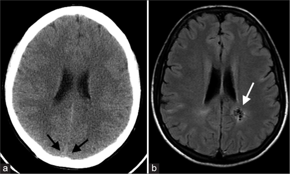 (a and b) This AVM was rated as undetectable on non-contrast CT (a). While the corresponding image from an MR FLAIR sequence demonstrates multiple flow voids consistent with an AVM (white arrow, b), there was no high attenuation from the AVM nidus or supplying vessels visible on CT even in retrospect. But note the low contrast between the brain cortex and superior sagittal sinus (black arrows, a), which measured 49 HU centrally. The low contrast between this patient’s intravascular blood and normal brain may contribute to the low conspicuity of this AVM on non-contrast CT.