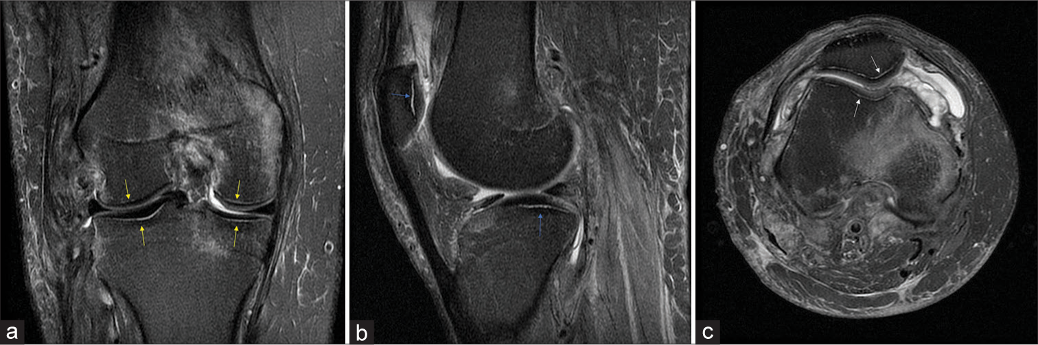 Same patient as above. Images from non-contrast knee magnetic resonance imaging. (a) Coronal T2 fat-saturated imaging shows band-like subchondral T2 hyperintensity involving the femoral condyles and tibial plateau (yellow arrows). Also demonstrated was complete tearing of the ACL and PCL, partial tearing of the MCL, and an impaction fracture of the medial femoral condyle, (b) sagittal proton-density fat-saturated imaging shows band-like subchondral T2 hyperintensity involving the patella and lateral tibial plateau (blue arrows), (c) axial proton-density fat-saturated imaging shows band-like subchondral T2 hyperintensity involving the patella and trochlear groove (white arrows). Additionally there is an impaction fracture of the anterior medial femoral condyle with subperiosteal hematoma formation.