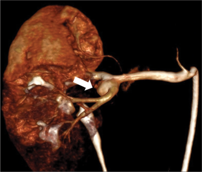 Computed tomography angiography 3D reconstruction in a 68-year-old male patient demonstrating the aneurysm arising from the distal right renal artery bifurcation (white block arrow).