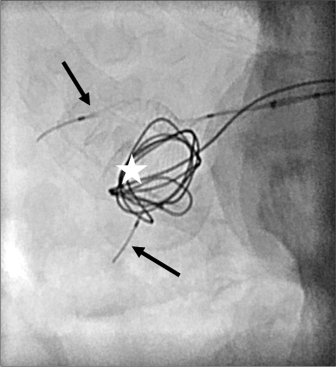 Fluoroscopic spot image in the 68-year-old male patient showing the Comaneci devices used as scaffolding in two separate segmental vessels (black arrows) during coil deployment (white star).