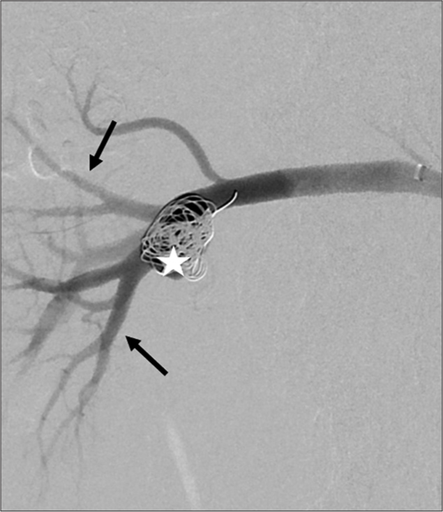 Digital subtraction angiogram of the right renal artery in a 68-year-old male patient showing successful coiling of the aneurysm (white star) with unchanged flow in the distal vessels (black arrows).