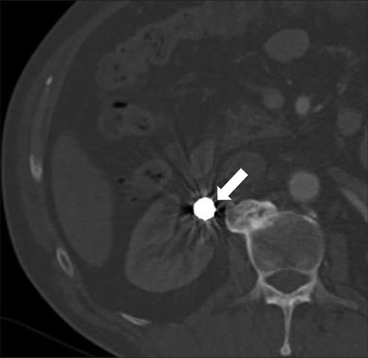 Follow-up contrast-enhanced computed tomography 1 month after the procedure in a 68-year-old male demonstrating successful embolization of the aneurysm (white arrow) with normal enhancement of the right kidney.