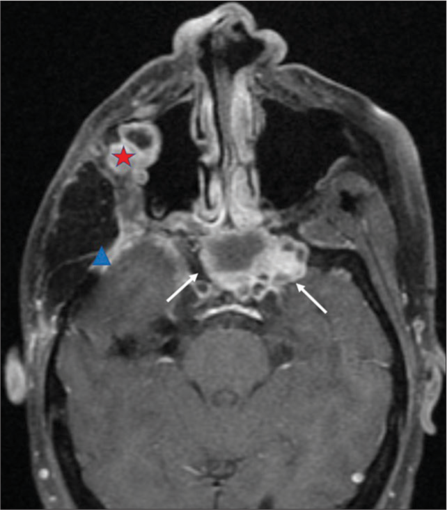 A 31-year-old male with a history of a jaw tumor presented with the right-sided headache and vision loss and subsequently found to have a large, heterogeneous mass involving the right masticator space on CT scan. Axial view of a contrast-enhanced MRI of the face performed for further characterization shows a large, multilocular cystic mass with avidly-enhancing nodular soft-tissue components associated with the right temporal fossa and extending medially to involve the clivus (white arrows), sphenoid buttress (blue triangle), and greater wing of the sphenoid (red star).