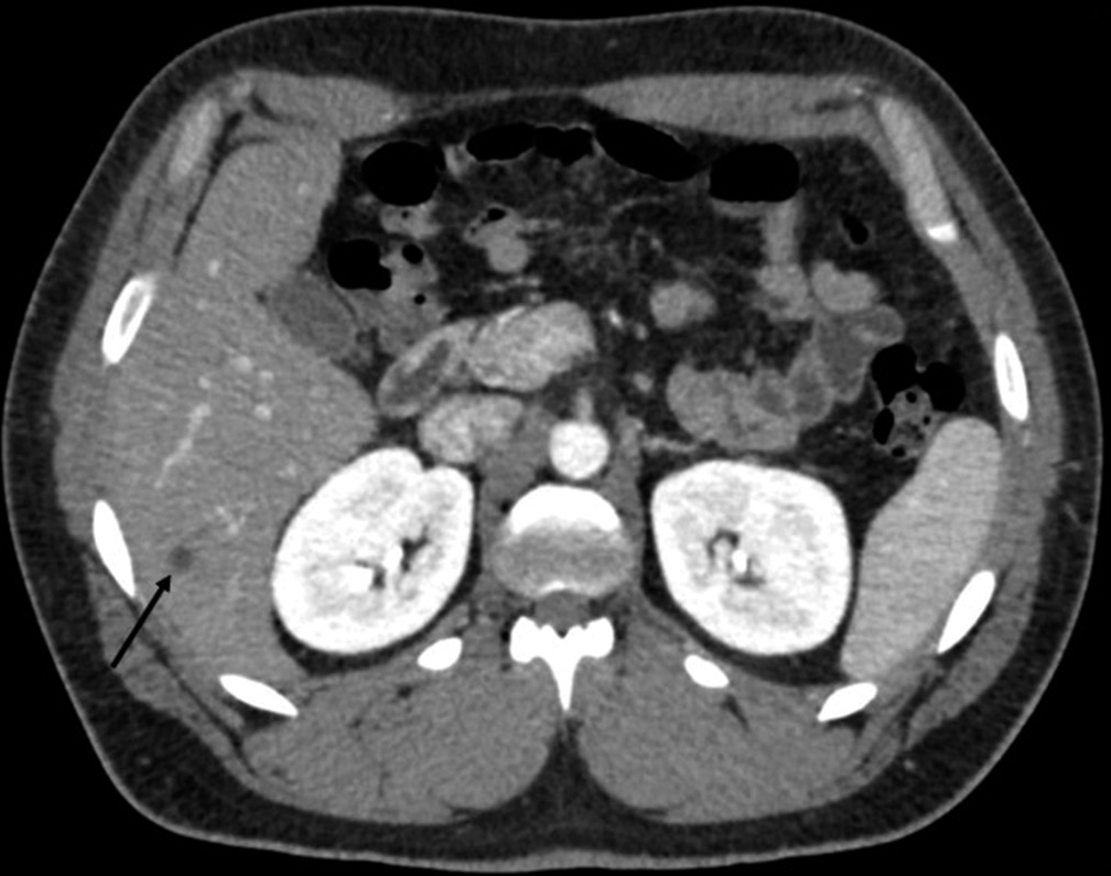 A 31-year-old male presented with a jaw tumor and was subsequently diagnosed with ameloblastic carcinoma. Axial view of a CT scan of the chest performed for staging reveals several small cystic lesions within the imaged portion of the liver, including a lesion in the posterior right hepatic lobe with irregular margins and attenuation slightly greater than simple fluid (black arrow).