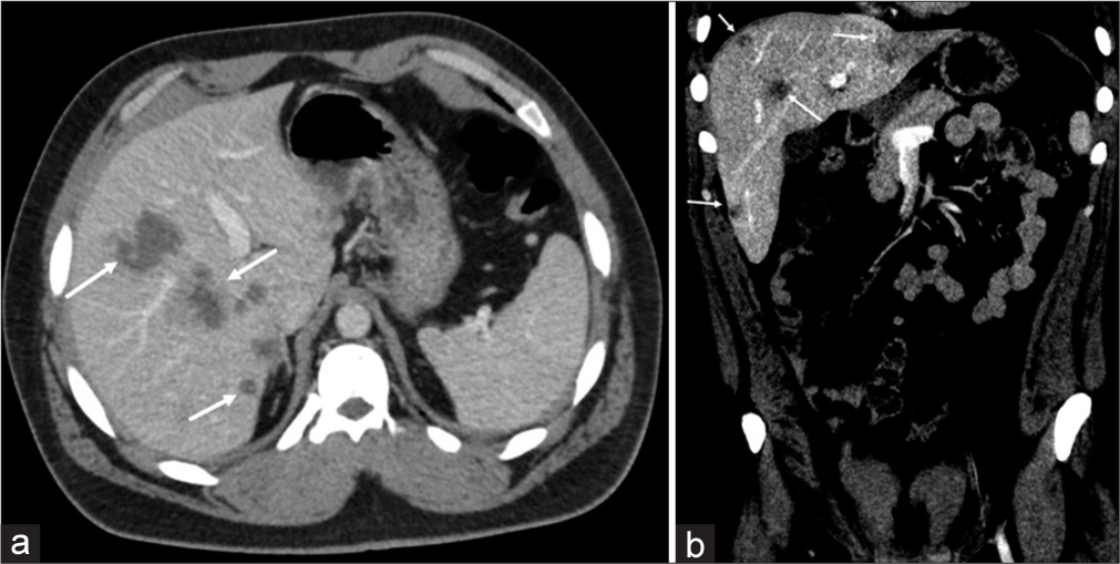 A 31-year-old male presented with a jaw tumor and was subsequently diagnosed with ameloblastic carcinoma. Initial staging CT scan of the chest showed several small cystic hepatic lesions, including a suspicious cystic hepatic lesion in the posterior right hepatic lobe. A CT scan of the abdomen and pelvis was performed 3 months later. Axial view (a) shows rapid interval growth of the cystic hepatic lesions (white arrows). Coronal view (b) illustrates the extent of disease, with hepatic lesions in segments 2, 5, and 8 (white arrows).