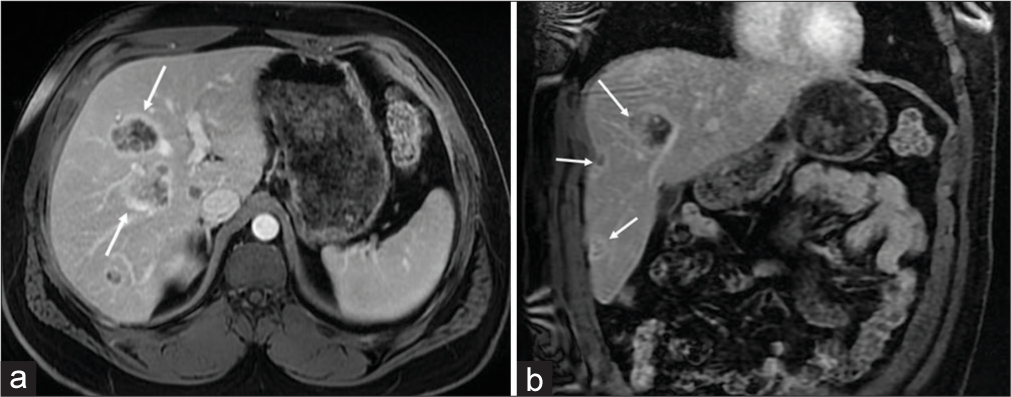 A 31-year-old male presented with a jaw tumor and was subsequently diagnosed with ameloblastic carcinoma with suspected hepatic metastases. Axial view (a) of a contrast-enhanced MRI of the abdomen demonstrates multiple cystic hepatic lesions with irregular morphology and avid peripheral enhancement (white arrows). Coronal view (b) shows extensive disease involving multiple hepatic segments and abutting branches of the hepatic vein (white arrows).