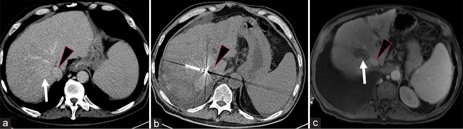 A 63-year-old female with NASH cirrhosis found to have LIRADS-5 lesion in hepatic segment VII. (a) Axial contrast-enhanced late arterial phase computed tomography (CT) images demonstrates a 2.6-cm arterially enhancing hepatocellular carcinoma (arrow) in segment VII near the IVC (arrowhead). (b) Axial CT image from the microwave ablation procedure shows probe directed to IVC (arrowhead). The tip is directed at the IVC. (c) Contrast-enhanced magnetic resonance imaging at 1-month shows ablation cavity (arrow) without residual disease and patent IVC (arrowhead).