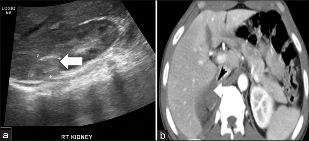A 56-year-old man presented with adrenal hemorrhage and presenting with abdominal pain. (a) Axial ultrasound image demonstrates resolving hematoma characterized by a hyperechoic rim (arrow), likely peripheral calcification, within the right adrenal gland. (b) In contrast-enhanced axial computed tomography image, there is acute hematoma (arrow) with peri adrenal fat stranding.