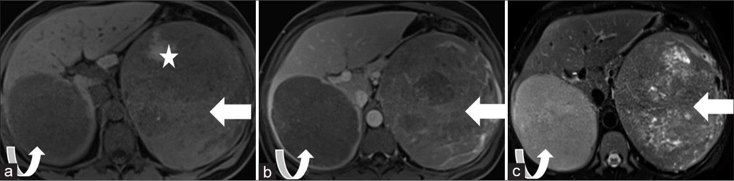 A 52-year-old female presented with adrenal carcinoma and presenting with abdominal distension. Axial (a) pre-contrast T1, (b) post-contrast T1, and (c) T2-weighted images show a large heterogeneous mass arising from the left adrenal gland (arrow). Notice the intrinsic T1 signal on the pre-contrast image showing hemorrhage (star). Metastasis is also noted in the posterior segment of the right hepatic lobe (curved arrow). Pathology demonstrated adrenal carcinoma.
