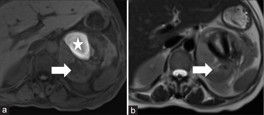 A 41-year-old male presented with pheochromocytoma and presenting with uncontrolled hypertension. Axial (a) T1-weighted and (b) T2-weighted MRI images demonstrate a large mass in the left adrenal gland (arrow) with an intrinsic high signal (star) on T1-weighted images secondary to hemorrhage in a pheochromocytoma.