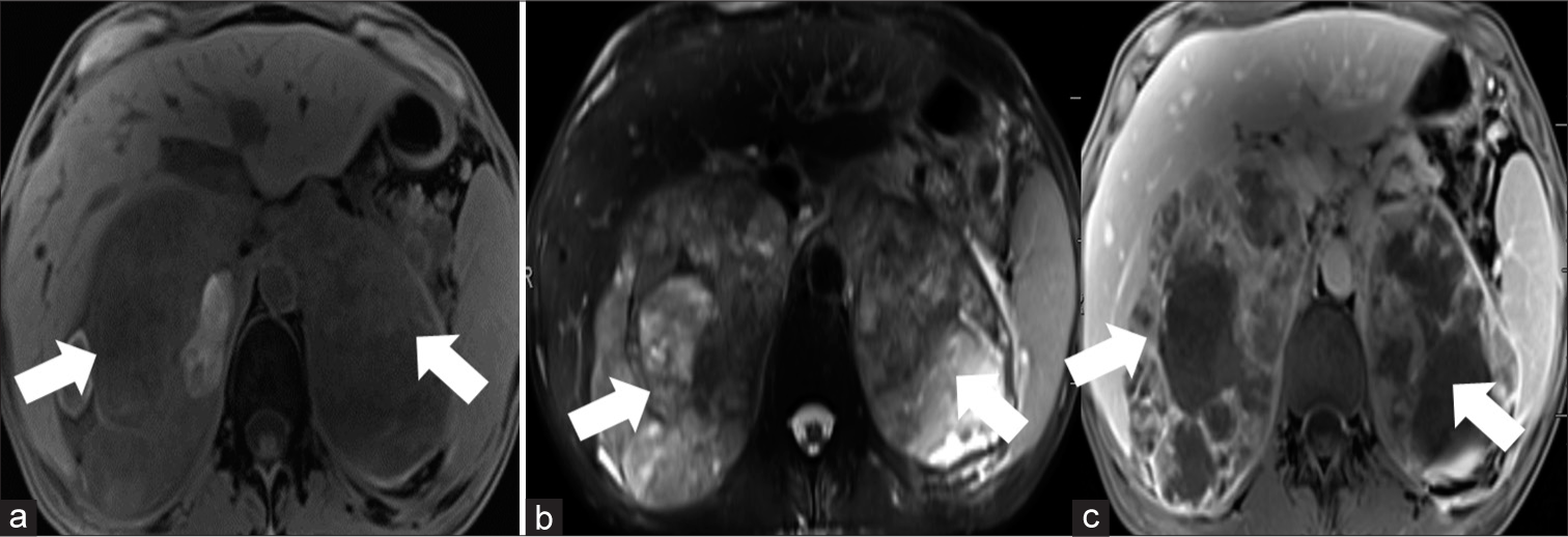 A 75-year-old male presented with bilateral adrenal metastases from lung adenocarcinoma and presenting with shortness of breath. (a) Axial T1-weighted, (b) axial T2-weighted, and (c) post-contrast T1-weighted images show bilateral large heterogeneous masses arising from bilateral adrenal glands (arrows) compatible with bilateral adrenal metastasis.