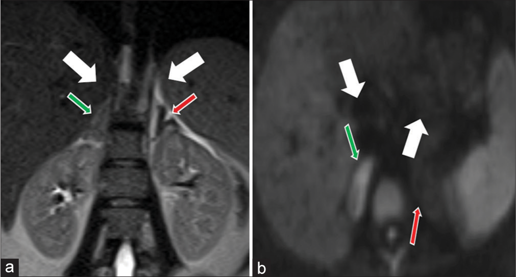 A 25-year-old pregnant female presented with the left adrenal infarction and presenting with the left flank pain. (a) Coronal T2-weighted image shows loss of normal signal in the left adrenal gland (red arrow) compared with the normal right adrenal gland (green arrow). (b) Axial DWI image shows loss of normal high DWI signal in the left adrenal gland (red arrow) compared with the normal right adrenal gland (green arrow) and consistent with the left adrenal infarction.