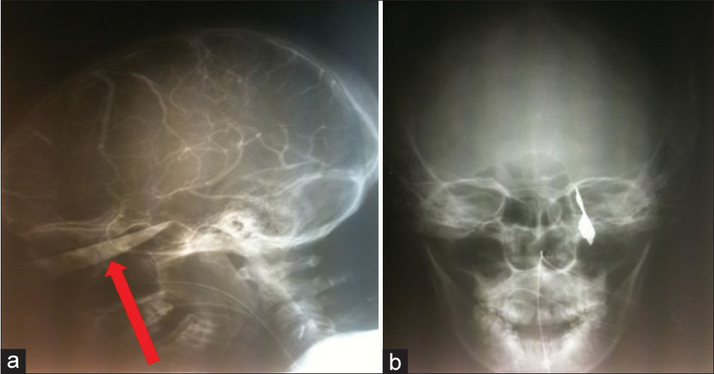 A 45-year-old patient presented with a penetrating injury to the right orbit. (a) Lateral and (b) anteroposterior radiograph demonstrating the knife (arrow) penetrating the orbit.