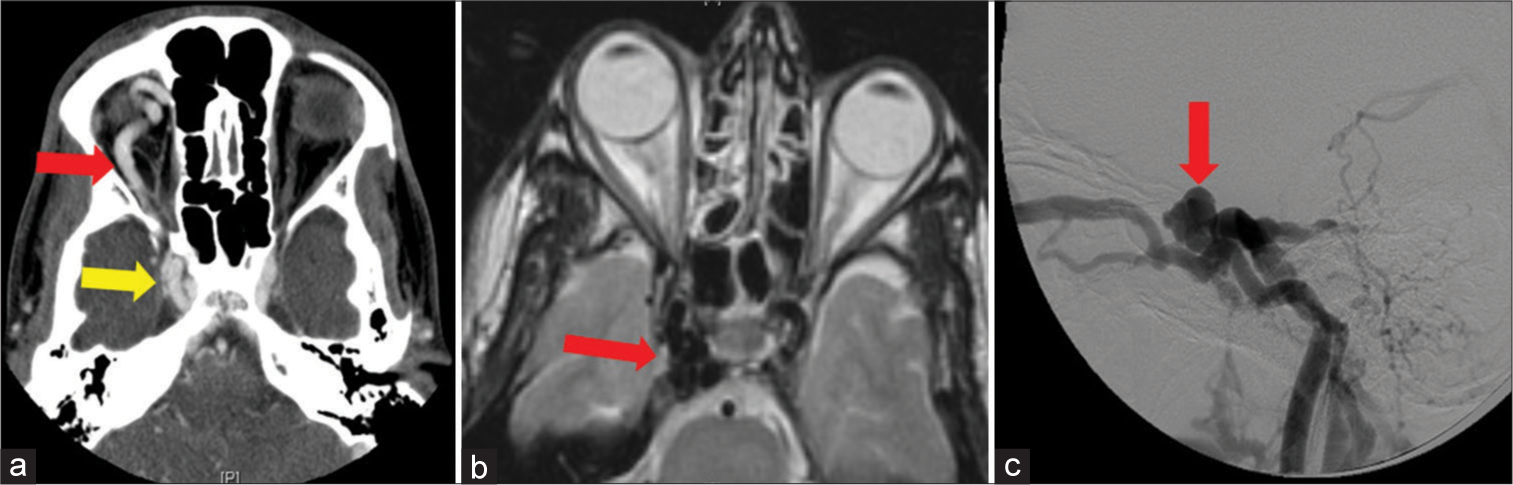 A 41-year-old patient presented with penetrating trauma to the cranium. (a) Axial post-contrast computed tomography shows enlarged right cavernous sinus (yellow arrow) with the dilated superior ophthalmic vein (red arrow). (b) T2-weighted MRI demonstrates mild proptosis of the right globe with multiple flow voids due to a CCF in the same patient (red arrow). (c) Right internal carotid artery (ICA) angiogram demonstrates opacification of the cavernous sinus due to fistulous communication at the C3 portion of the ICA and cavernous sinus (red arrow).