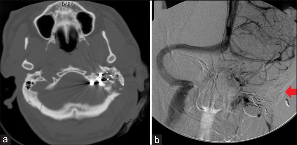 A 23-year-old patient presented with a gunshot wound to the left temporal bone. (a) Axial computed tomography demonstrates the fragmented left temporal bone secondary to the gunshot. (b) Cerebral venogram demonstrating an occluded left sigmoid sinus (arrow).