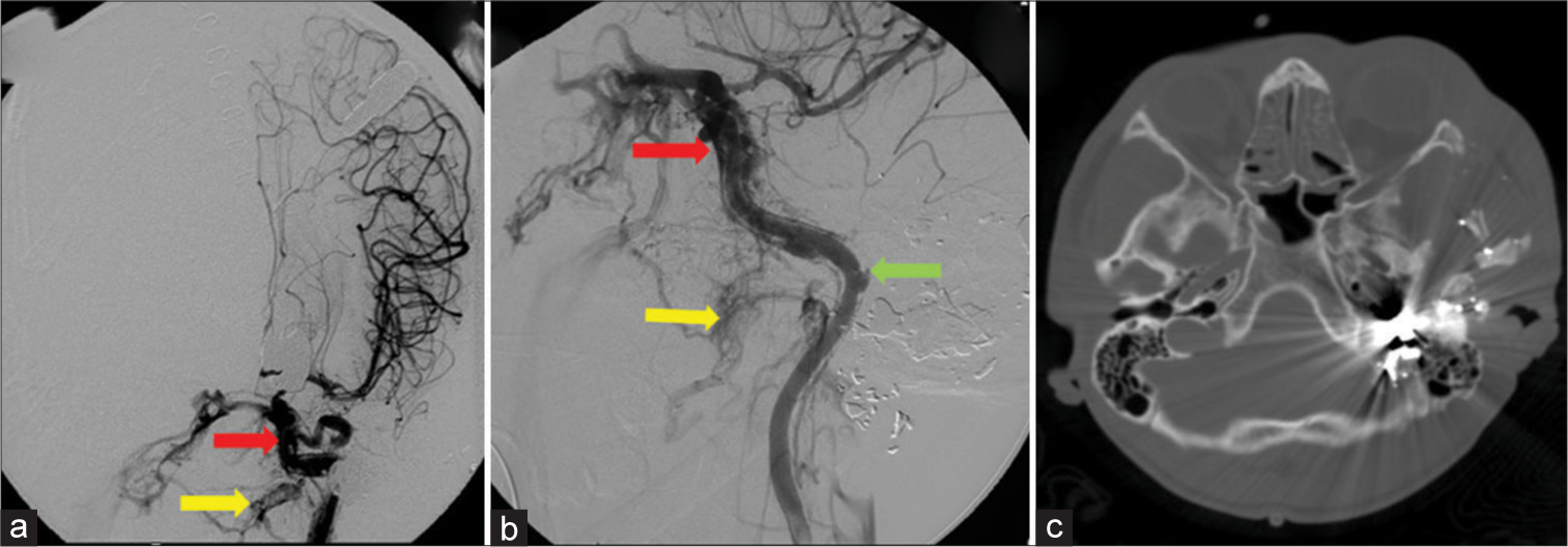 A 38-year-old patient presented with gunshot wound to the cranium. (a and b) Left internal carotid artery angiogram demonstrating traumatic arteriovenous fistula between the second portion of the left internal maxillary artery (pterygoid portion) to the left pterygoid venous plexus (red arrow). There is a second arteriovenous fistula of the petrous portion of the LICA to the left cavernous sinus (yellow arrow). Small pseudoaneurysm in the petrous portion of the LICA (green arrow). (c) Axial non-enhanced computed tomography of the same patient with GSW to face and skull base.