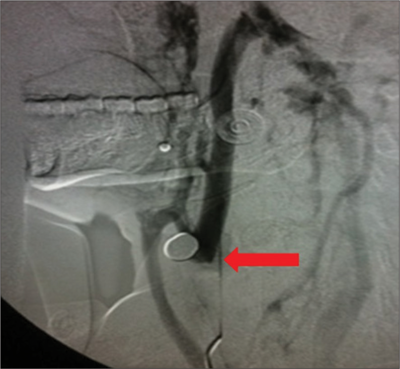 A 35-year-old patient presented with a stab wound to the cranium. Venogram demonstrates occluded and/or transected left jugular vein (arrow).