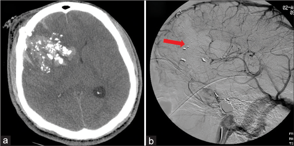 A 29-year-old patient presented with a gunshot wound to the cranium. (a) Axial computed tomography of the brain demonstrating hemorrhagic contusion in the right frontal lobe with overlying bullet fragments after GSW. (b) Delayed cerebral venogram of the same patient demonstrating occlusion (arrow) of the right superficial middle cerebral and vein of Trolard.