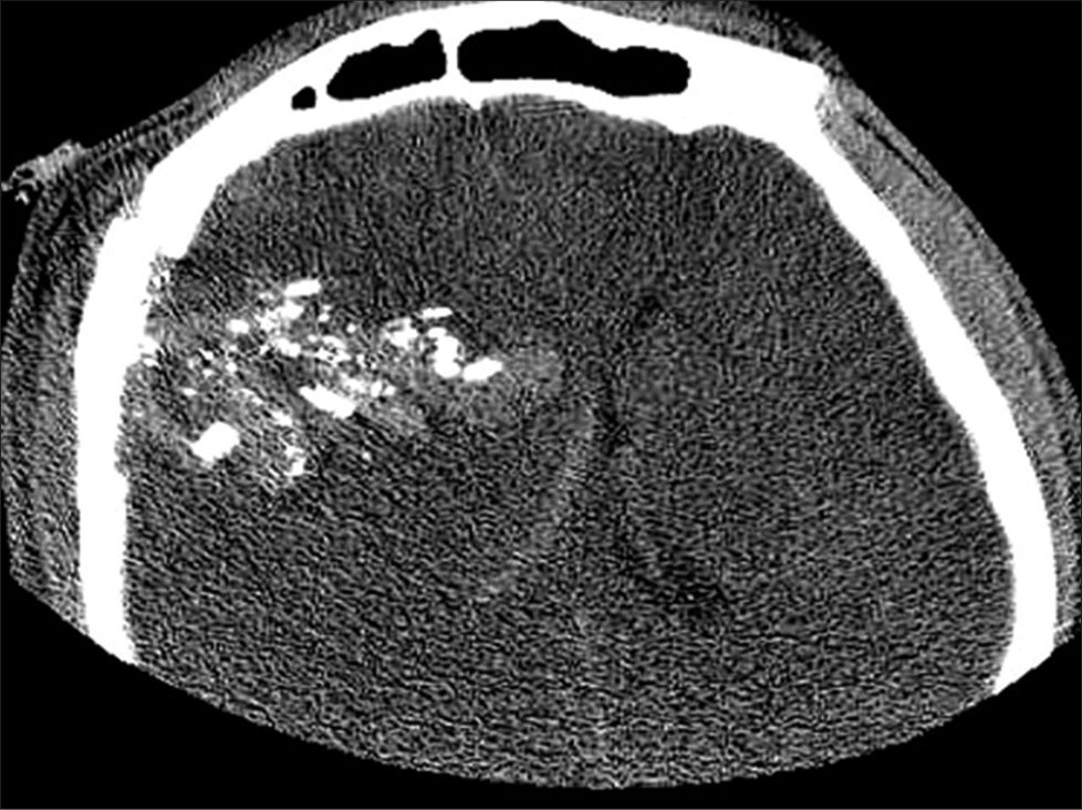 A 43-year-old patient presented with a gunshot wound to the cranium. Axial section of computed tomography head demonstrating hemorrhagic contusion in the right frontal lobe with overlying bullet fragments.