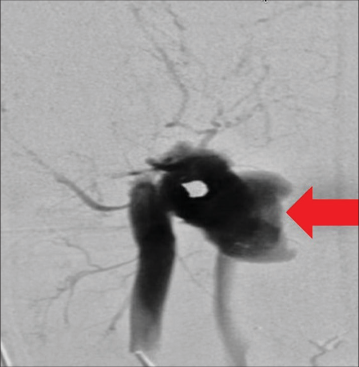 A 23-year-old patient presented with a gunshot wound to the neck. Internal carotid artery angiogram demonstrating a large pseudoaneurysm (arrow) of the common carotid artery in neck Zone I.