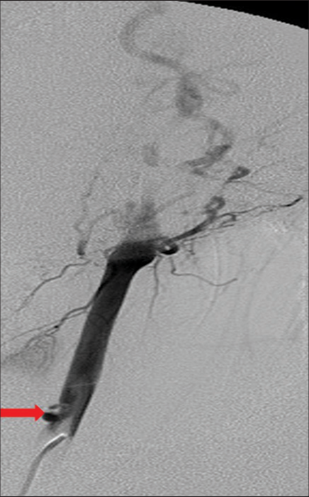 A 27-year-old patient presented with a penetrating injury to the neck. Common carotid artery angiogram demonstrates a focal dissection of the common carotid artery (arrow) with a non-occlusive intimal flap in Zone 2 of the neck.