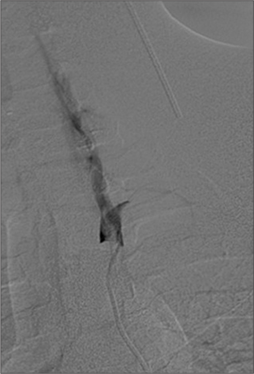 A 31-year-old patient presented with a stab wound to the neck. Vertebral angiogram demonstrating flow limiting dissection in the vertebral artery.