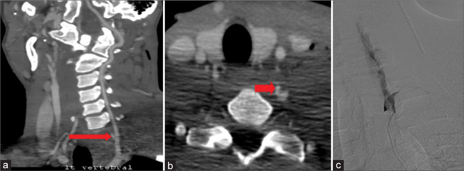 A 27-year-old patient presented with a stab injury to the neck. (a and b) computed tomographic angiography demonstrates a small focal aneurysm in the left V1 segment (arrow) (c) Subsequent angiogram shows slow flow through the left vertebral artery due to associated dissection.