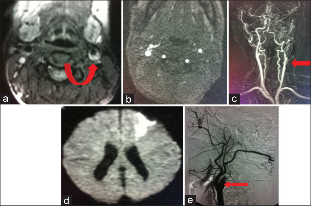 A 55-year-old patient presented with iatrogenic penetrating injury to the neck secondary to catheter intervention for aneurysm coiling. (a) Intramural hematoma (arrow) of the left internal carotid artery (ICA) wall is demonstrated on T1 fat-saturated pre-contrast MRI. (b) 2D flow image shows no flow in left ICA. (c) Contrast MRA shows complete occlusion (arrow) of left ICA. (d) Patient with stroke in watershed ACA/MCA territory. (e) Angiogram confirmed occlusive left ICA dissection (arrow).
