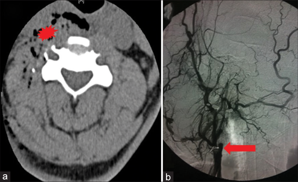 A 19-year-old patient presented with a stab wound to the right side of the neck. (a) Axial computed tomography head demonstrating air (star) secondary to stab wound. (b) Angiogram demonstrating the right carotid artery that shows complete occlusion.