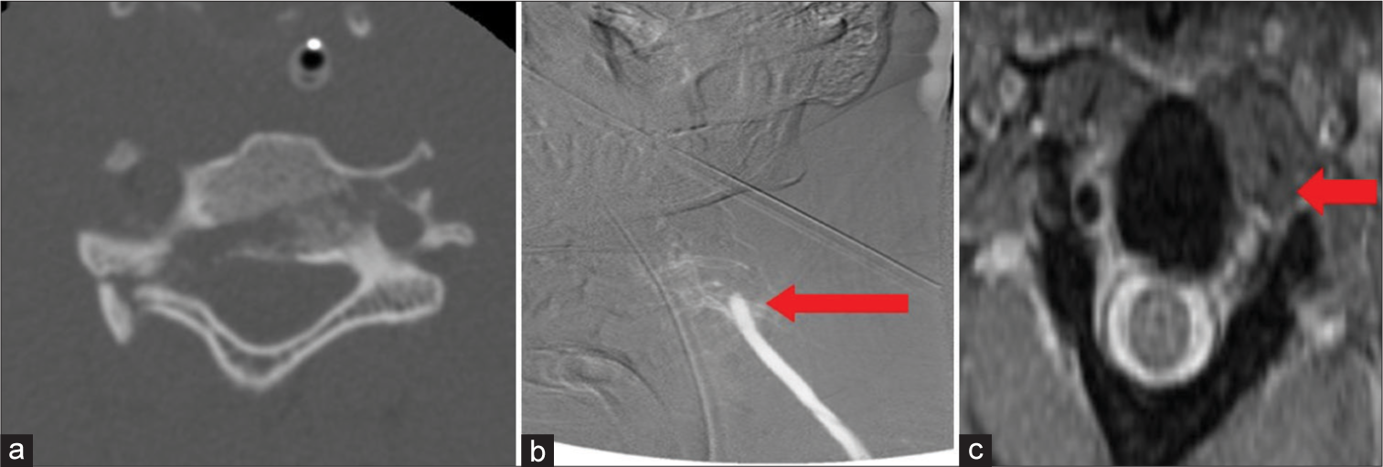 A 33-year-old patient presented with a gunshot wound to the back of the neck (C5 vertebra). (a-c) Axial computed tomography, angiogram, and axial T2 MRI demonstrate complete occlusion (arrow in b) of the left vertebral artery and absent flow void (arrow in c) on the axial T2 MRI sequence.