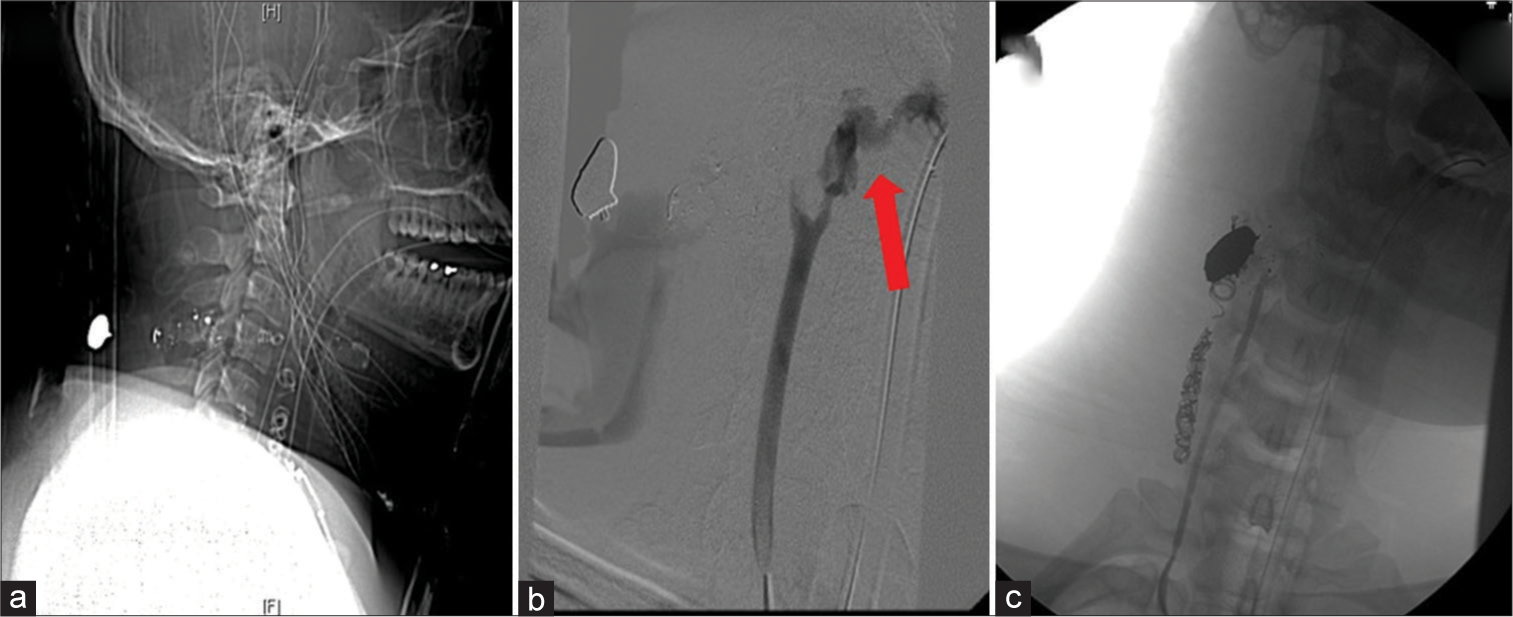 A 25-year-old patient presented with a gunshot wound to the neck (a) computed tomography scout demonstrating GSW to zone 2 of the neck (b and c) angiogram of the same patient demonstrating extravasation (arrow) from the right distal common carotid artery, which was embolized.