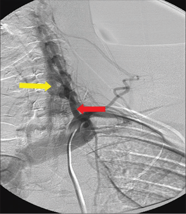 A 29-year-old patient presented with a stab wound to the neck. Left vertebral angiogram demonstrating traumatic arteriovenous fistula from the vertebral artery (yellow arrow) to the left internal jugular vein (red arrow).