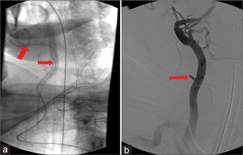 A 36-year-old patient with history of central line placement. (a and b) Angiogram demonstrating a pseudoaneurysm of the common carotid artery after inadvertent central line placement in CCA.