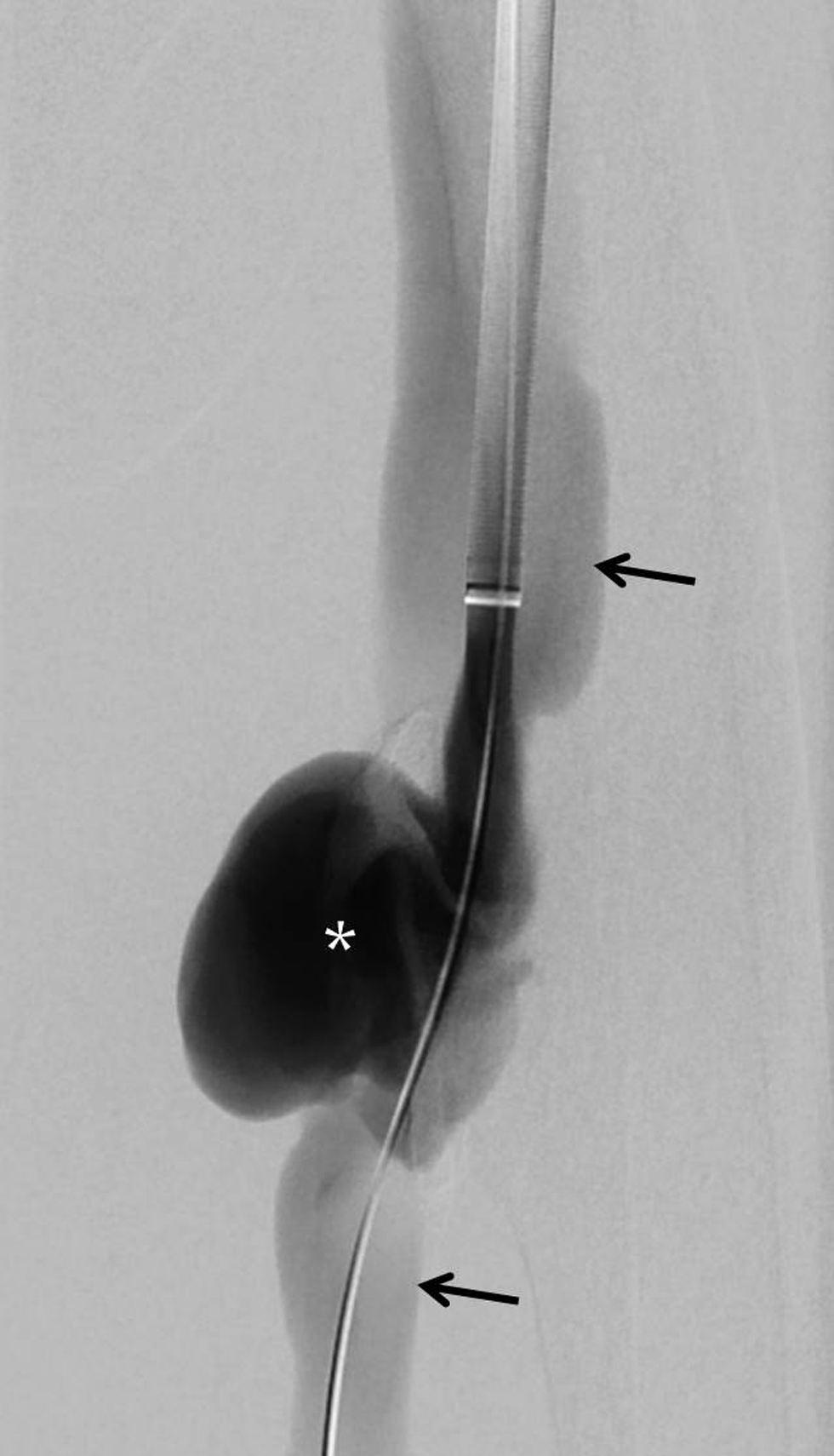 A 60-year-old man with post-traumatic chronic femoral pseudoaneurysm with arteriovenous fistula. Digital subtraction angiogram performed by contrast injection through the sheath showing the pseudoaneurysm (asterisk), antegrade and retrograde opacification of the veins (black arrows), and absent contrast flow in the arteries distal to the fistula site.
